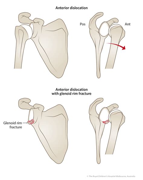 Clinical Practice Guidelines : Shoulder Dislocations - Emergency Department