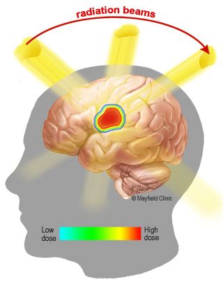 Stereotactic Radiosurgery (SRS) - Asian American Radiation & Oncology