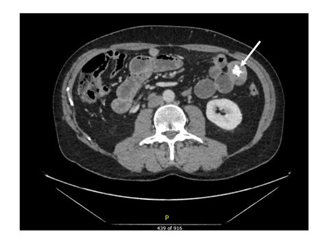 Enteroliths formed in jejunal diverticula causing ileus | Eurorad