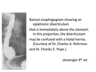 Epiphrenic diverticulum | PPT