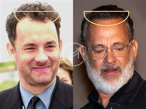 Tom Hanks Hair Transplant - Hair Loss & Technical Analysis