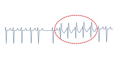 Ashman phenomenon in atrial fibrillation – All About Cardiovascular System and Disorders