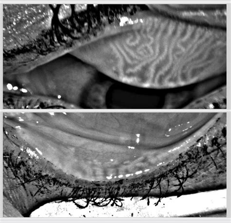 Intraductal Meibomian Gland Probing in Patients With Obstructive Meibomian Gland Dysfunction ...