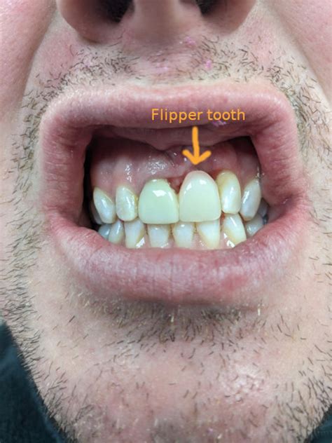 Flipper Tooth: Things To Know - 1311 Jackson Ave Dental | Dentist in ...