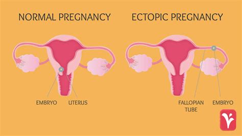 Thread by @DrAtangwho: POLYCYSTIC OVARY SYNDROME: What you need to know Affected women usually ...