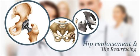 Hip Resurfacing vs Hip Replacement: Know The Difference | MediGence