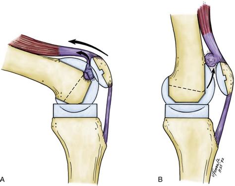 Complications of Total Knee Arthroplasty | Musculoskeletal Key