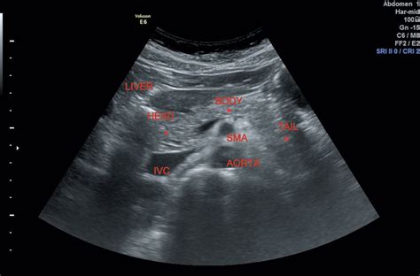 Pancreas | Radiology Key