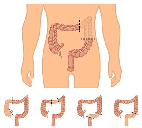 Laparoscopic Colon Resection - Johns Creek, Alpharetta, Roswell ...