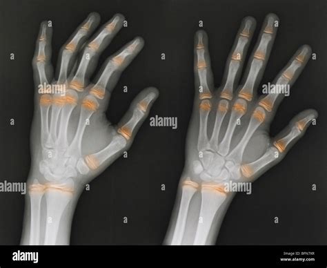 hand x-ray 12 year old male, two views with the epiphyseal growth ...