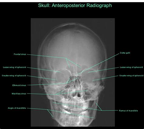 Dentistry lectures for MFDS/MJDF/NBDE/ORE: Diagrams Of Anatomy Of Skull With Radiographic Land Marks