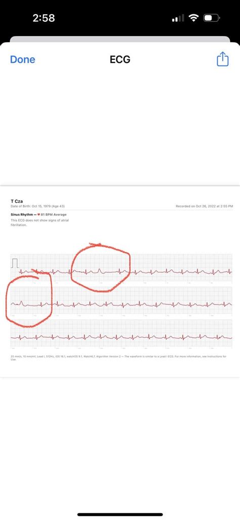 Heart feels like it’s skipping beats : r/PVCs