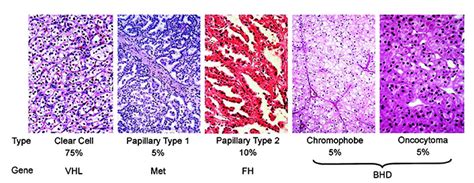 Types of Kidney Cancer | rarekidneycancer.org