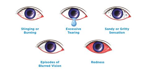 Dry Eye Syndrome Symptoms Brooks Eye Associates - vrogue.co