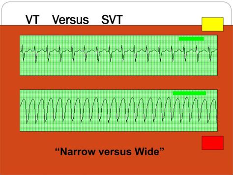 PPT - Cardiovascular--- EKG’s / Cardiac Monitoring PowerPoint Presentation - ID:2350898