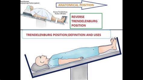 TRENDELENBURG POSITION | REVERSE TRENDELENBURG POSITION | [DEFINITION ...