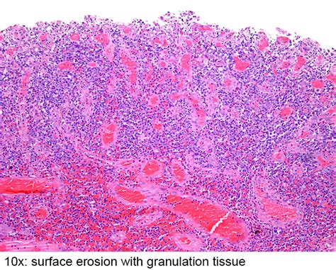 Pathology Outlines - Inflammatory polyp