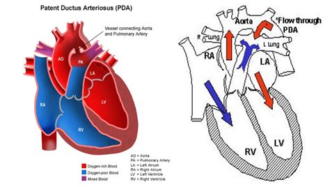 Patent Ductus Arteriosus | www.imgkid.com - The Image Kid Has It!