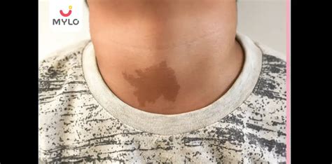 Birthmark: Types, Causes, Risks & Treatment | MyloFamily