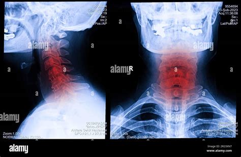 X-ray of neck and cervical spine view. Image of radiography from patient who have neck pain ...