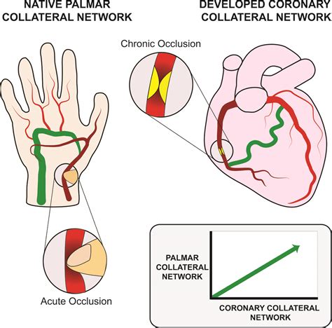 Coronary Collateral Flow Index Is Correlated With the Palmar Collateral Flow Index ...