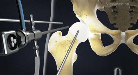 Hip Bone Spur Removal Surgery Video