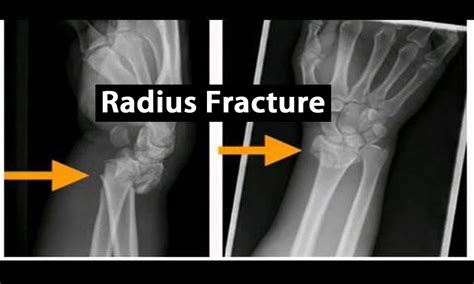 Distal Radius Fracture Exercises