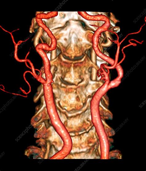 Carotid artery disease, 3D CT angiogram - Stock Image - C033/7382 ...