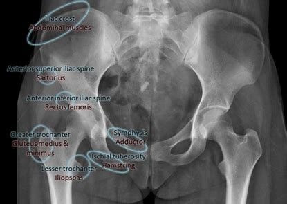 Anterior Inferior Iliac Spine