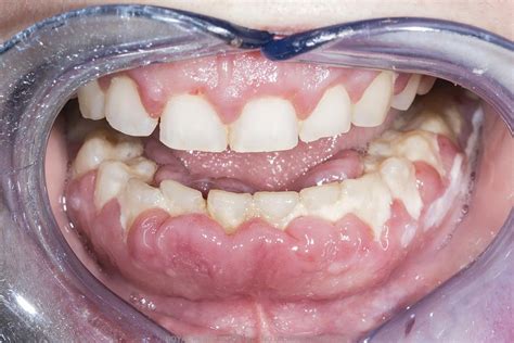 Swollen gums in a young adult | The BMJ