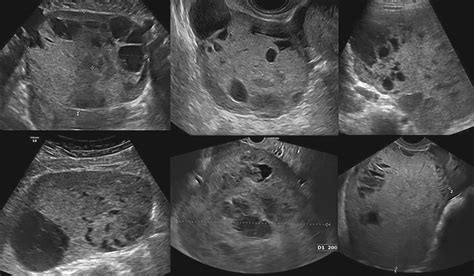 Yolk Sac Tumor Ultrasound