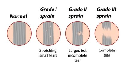 The Difference Between A Sprain And A Strain | Kintec