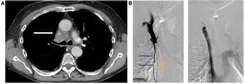 Palliative treatment of superior vena cava syndrome with use of stent – Atlas of Science