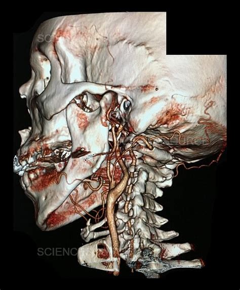 Common Carotid Artery Bifurcation, 3D | Stock Image - Science Source Images