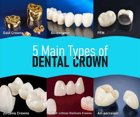 Types of Dental Crowns: Procedure and Cost