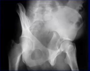 Acetabular Fracture Classification: Associated Fracture Types ...