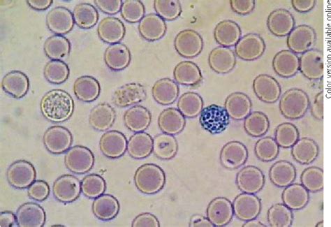 A Newly Modified Hemoglobin H Inclusion Test as a Secondary Screening for α⁰-Thalassemia in ...