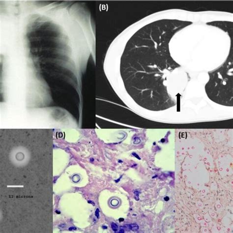 Representative (A) chest X-ray showing pulmonary Cryptococcus gattii ...