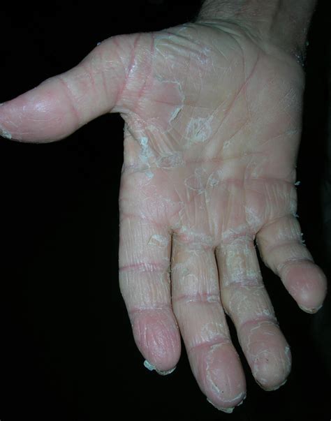 Keratolysis exfoliativa (Lamellar dyshidrosis, Recurrent focal palmar peeling, Recurrent palmar ...