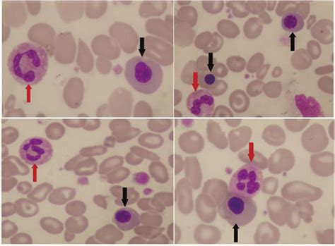 − A peripheral blood smear (100×): Leishman's stain indicating ...