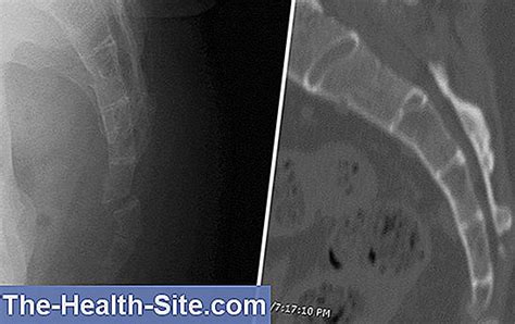 Coccyx Fracture: Development, Symptoms, Treatment 💊 Scientific ...