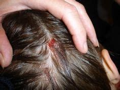 8 Best Sores on Scalp ideas | sores on scalp, scalps, soreness