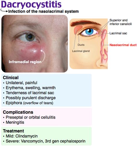 Dacryocystitis | Medical knowledge, Medical education, Family nurse ...