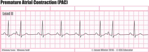 ECG Educator Blog : Premature Atrial Contraction (PAC)