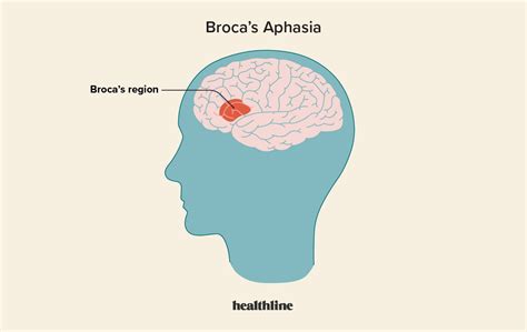 Broca’s Aphasia: Symptoms, Treatments, Types, and Outlook