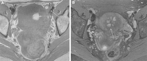 1Complications of endometrial ablation. A Axial T1W MR shows... | Download Scientific Diagram