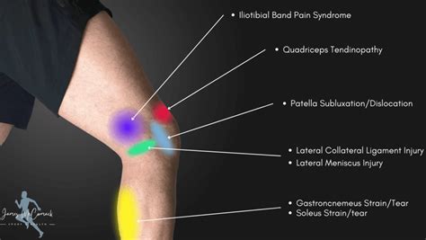 Knee Pain Location Chart | Learn the Pain Location of Knee Injuries