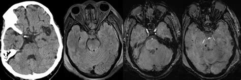 Diffuse Axonal Injury. Same Patient as in Fig. 4. Axial nonenhanced CT... | Download Scientific ...