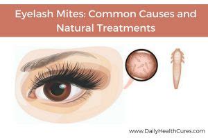 Eyelash Mites Are A Real Thing and Yeah, You Probably Have Them - Love and Marriage