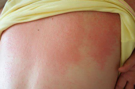 Heat Rash Symptom – Medical Symptoms Guide